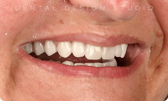dental implant in cancun